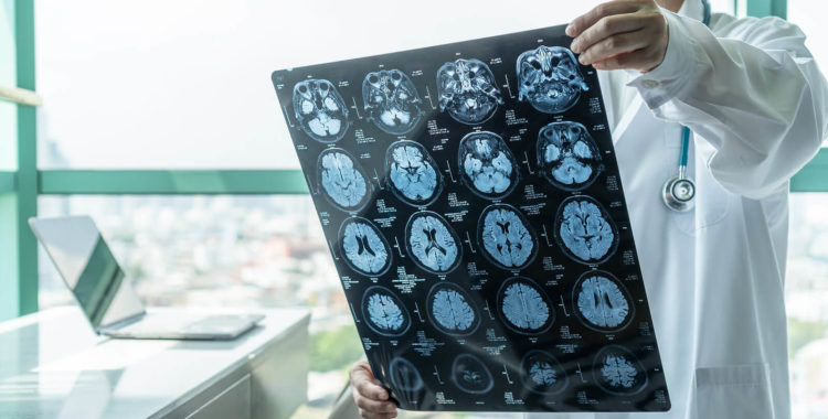 Brain disease diagnosis with medical doctor seeing Magnetic Resonance Imaging (MRI) film diagnosing elderly ageing patient neurodegenerative illness problem for neurological medical treatment