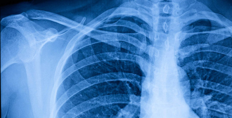 Human Thoracic cavity X-ray Film