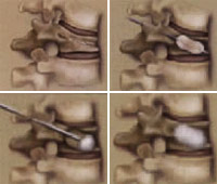 Degenerative disc disease – AEGIS Orthopaedics Pty Ltd