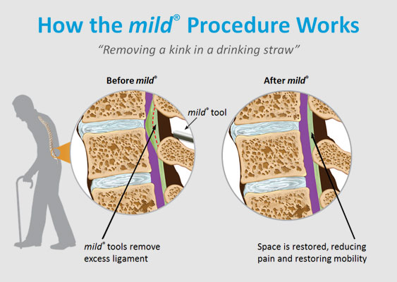 Everything You Need to Know About mild® for Spinal Stenosis: Pain Specialty  Group: Pain Management