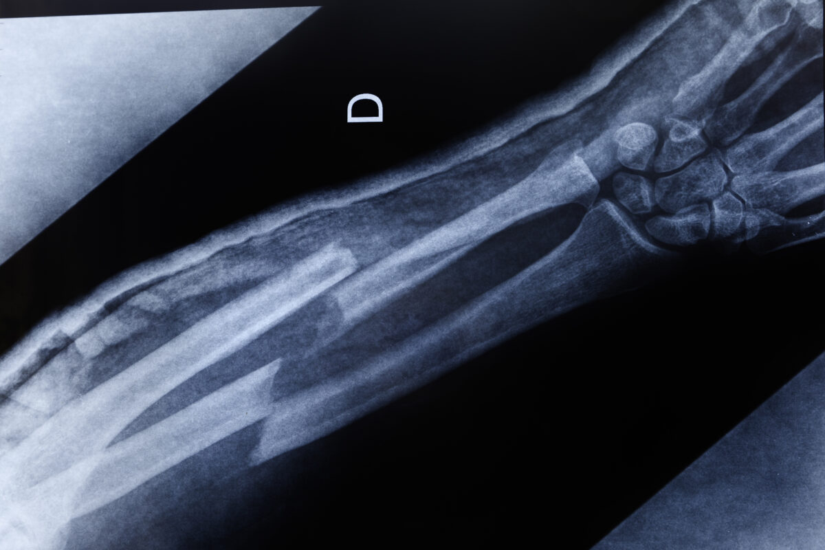 broken arm x-ray