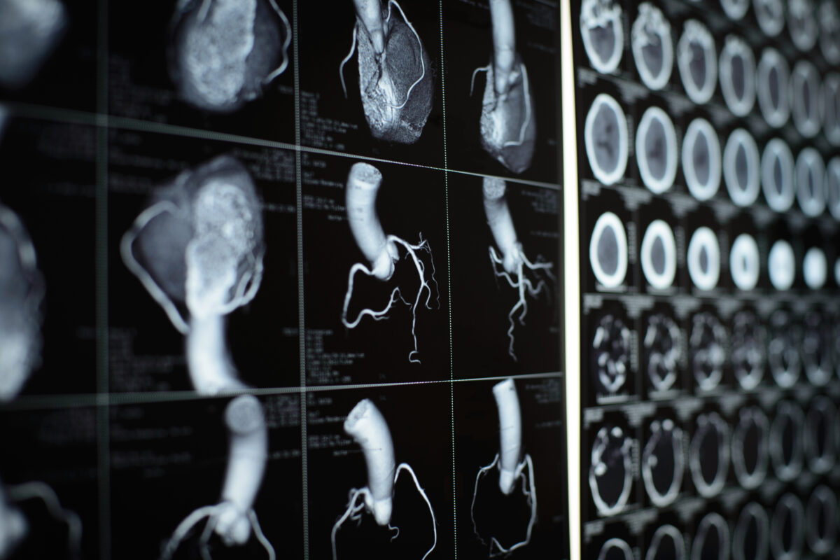 human heart and coronary artery  images