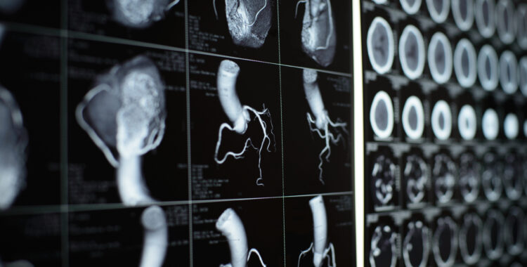human heart and coronary artery images